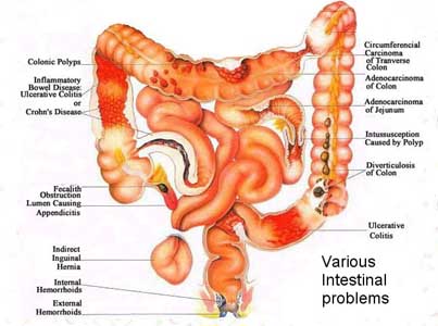 stomach nodules symptoms stomach cancer experience